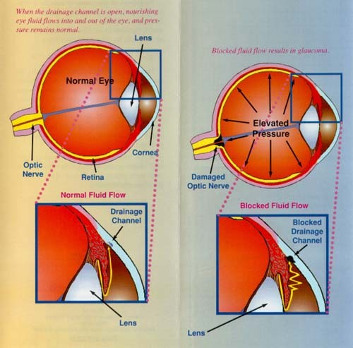 glauoma